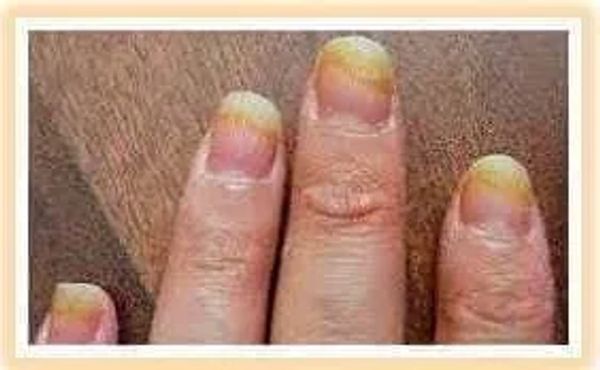 Nail Fungus on fingers