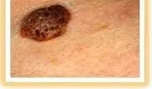 Skin cancer picture