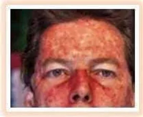 severe sunburn on face