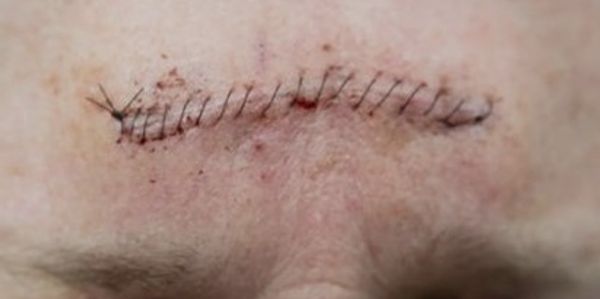 Mohs Surgery Stitches