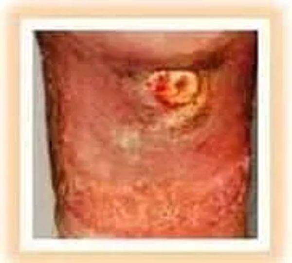 severe skin ulcer picture
