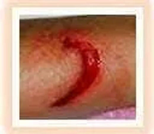 wound example