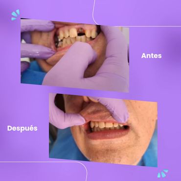 Prótesis dentales, antes y después