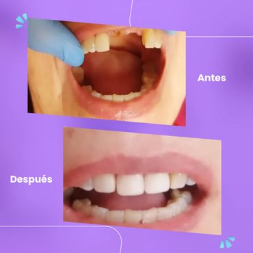 Prótesis dental, antes y después. Consultorio de la Dra. Patricia Garduño en Ermita Iztapalapa