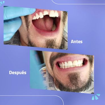 Resina estética, servicio odontológico de la Dra. Patricia Garduño