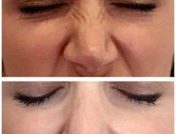 botox nasalis bunny lines nose wrinkles botox dysport pembroke petawawa renfrew