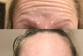 frownlines forehead pembroke petawawa botox dysport wrinkles renfew