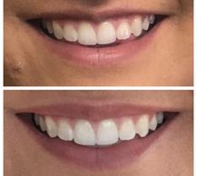 gummy smile lips lip flip botox dysport injections pembroke petawawa renfrew