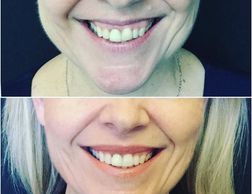 lip flip botox gummy smile botox dysport pembroke petawawa renfrew