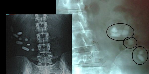 XRay Undigested Vitamins