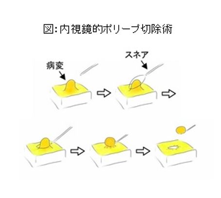 内視鏡的ポリープ切除術:図