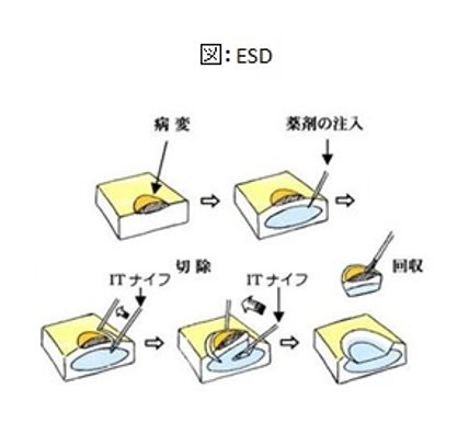 内視鏡的粘膜下層剥離術(ESD):図