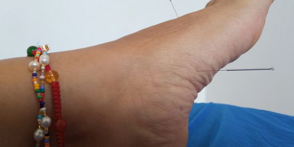 Woman's foot with two acupuncture needles and beaded foot bracelet