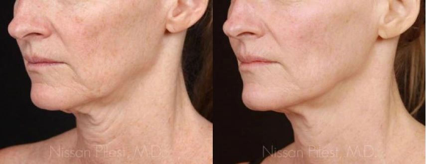 Chin reduction