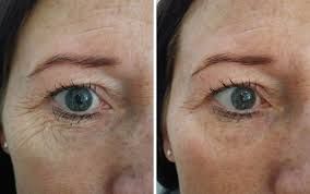 Wrinkle reduction