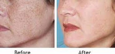 Hyperpigmentation treatment