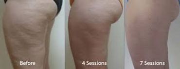 Cellulite reduction