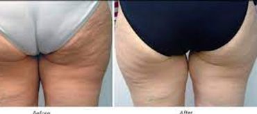 Cellulite reduction