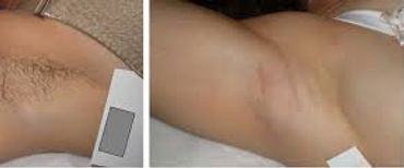 Hair removal/ reduction