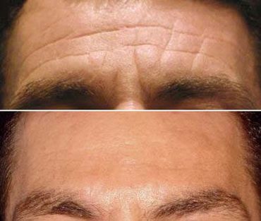 Men’s wrinkle treatment