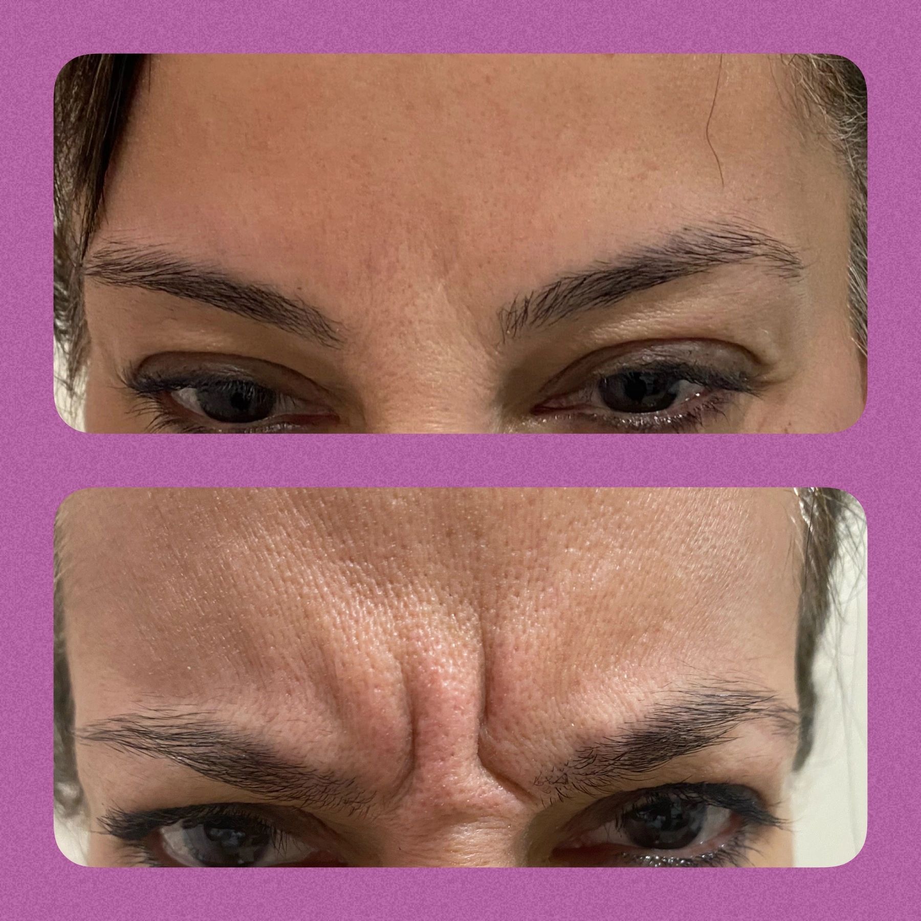 Before and after Botox treatment of  glabellar loonies