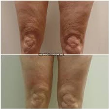Cellulite reduction