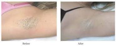 Laser hair removal/ reduction