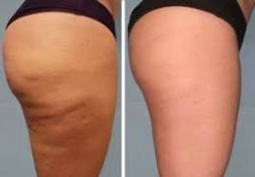 Cellulite reduction