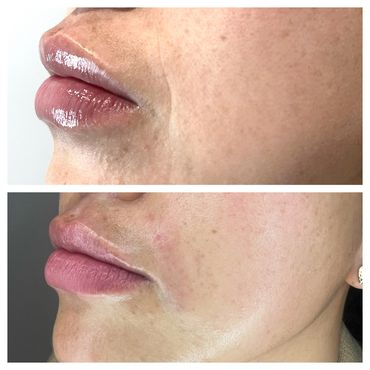 1ml Dermal filler Juvederm