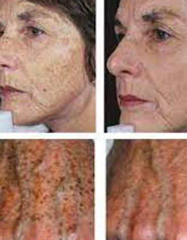 Sun spots, hyperpigmentation treatment