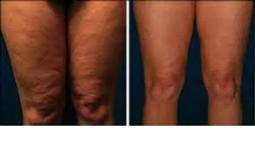 Cellulite reduction