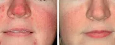 Facial redness treatment