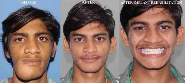 jaw cyst and tumor, best maxillofacial surgeon of India