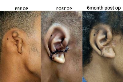 Ear Reconstruction surgery using rib cartilage for microtia correction