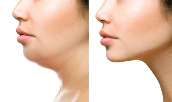 Chin and Jaw Line Contouring, V shape Jawline surgery, jawline contouring surgery, square face