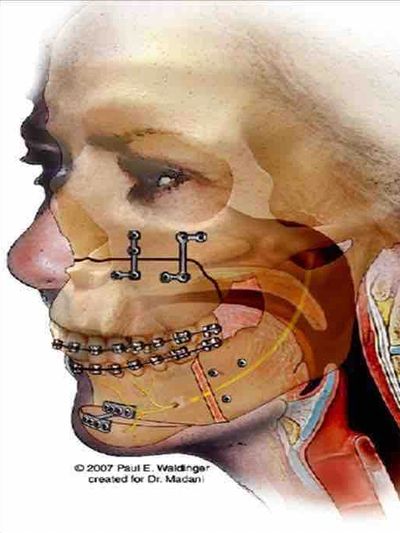 Corrective Jaw Surgery / Orthognathic Surgery / Jaw Surgery Cost in India.