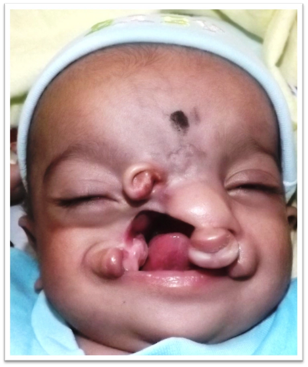 What is facial Cleft 