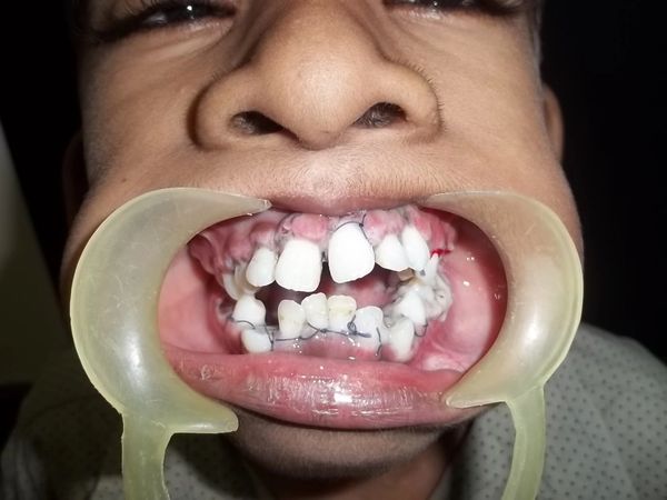 Gingival Hyperplasia, Phenytoin, Gum, Bleeding