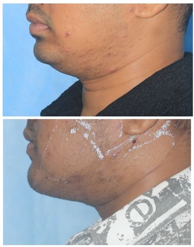 Double Chin Surgery In Mumbai, Double Chin Surgery in India, Cost For Double Chin Reduction