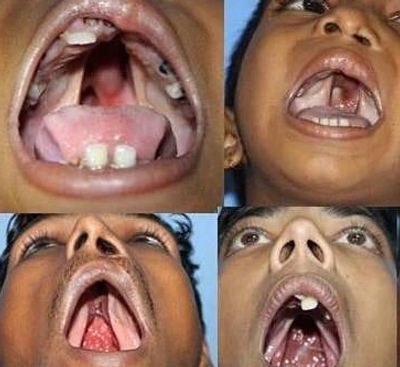 Fact about Cleft Palate