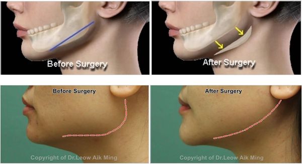 V shape jawline surgery
Angle reduction surgery
Double chin correction
Facial Implant
