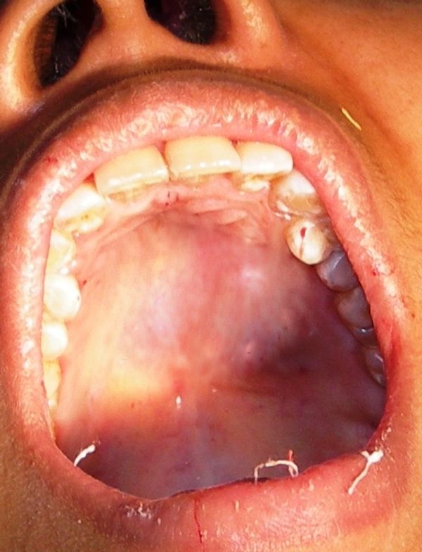 Pleomorphic Adenoma, Salivary gland tumour, excision, palate, tongue, jaw