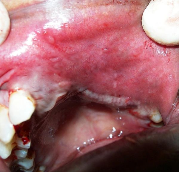 Maxilla, Mandible, Osteomyelitis, mucormycosis, fungal infection, necrosis, defect closure