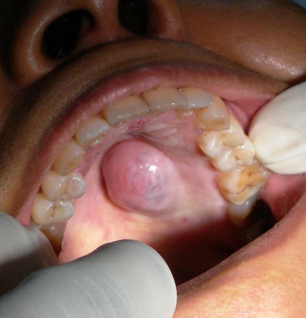 Pleomorphic Adenoma, Salivary gland tumour, excision, palate, tongue, jaw