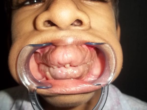 Gingival Hyperplasia, Phenytoin, Gum, Bleeding