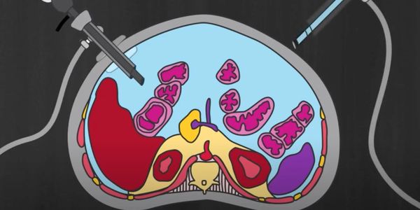 PIPAC for peritoneal cancer, hope for patients with peritoneal carcinomatosis