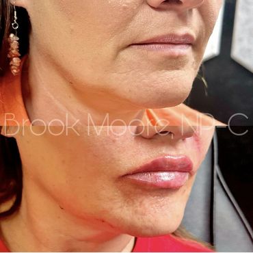 female patient's face before and after lip filler
