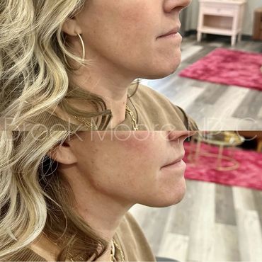 female patient's face before and after filler