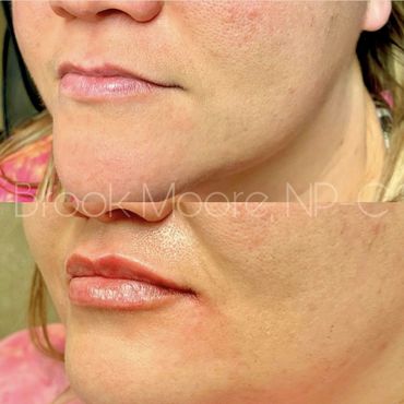 female patient's face before and after filler