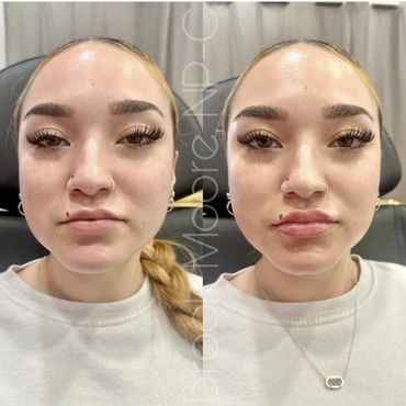 female patient's face before and after filler